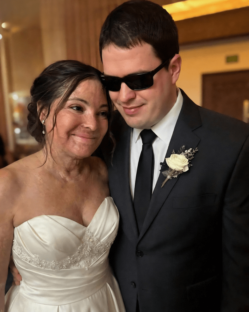 I Married a Blind Man So He’d Never See My Scars – On Our Wedding Night, He Said, ‘You Need to Know the Truth I’ve Been Hiding for 20 Years’