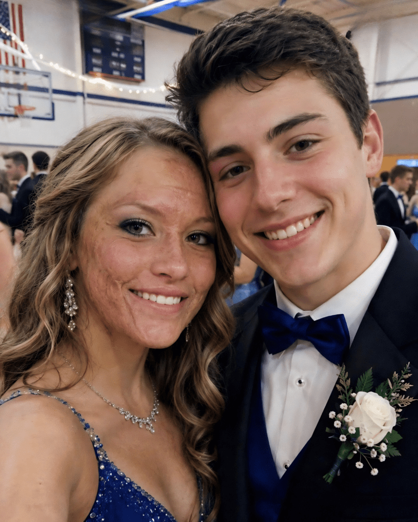 A Boy Asked Me to Dance at Prom Because No One Else Would Due to My Scars – The Next Day, His Parents and Officers Showed up at My Door